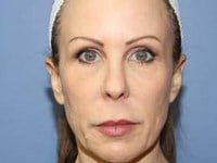 Fillers Before & After