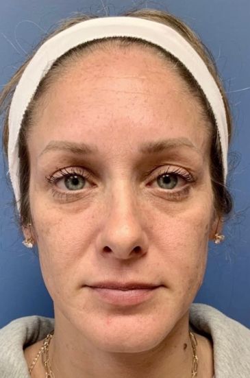 Fillers Before & After