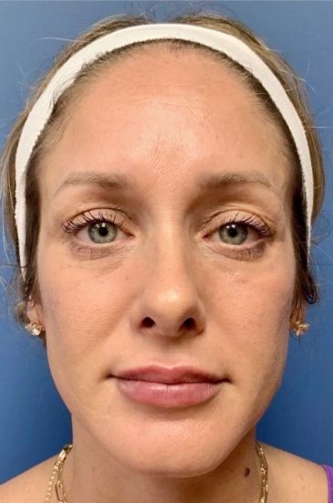 Fillers Before & After