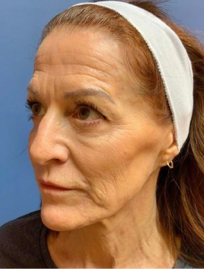 Fillers Before & After