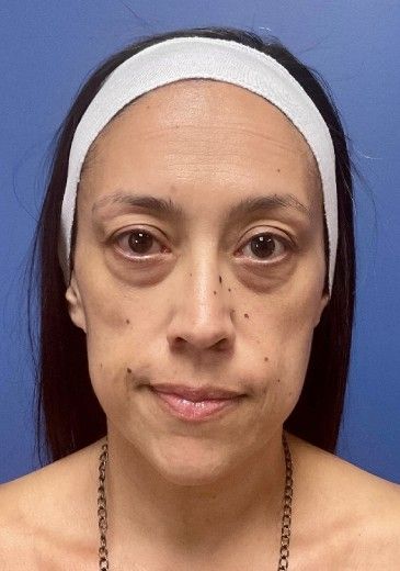 Fillers Before & After