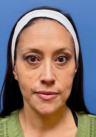 Fillers Before & After