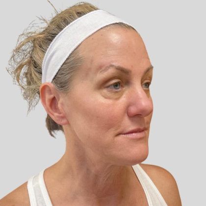 Fillers Before & After