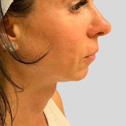 Fillers Before & After