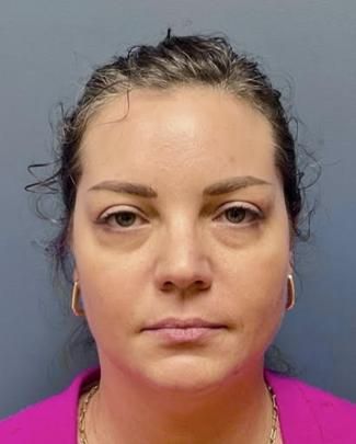 Fillers Before & After