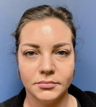 Fillers Before & After