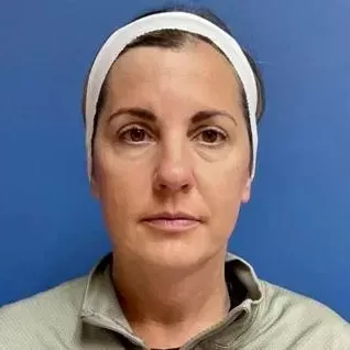 Fillers Before & After