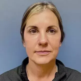 Fillers Before & After