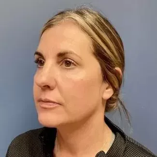 Fillers Before & After