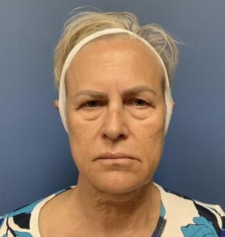 Fillers Before & After