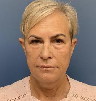 Fillers Before & After