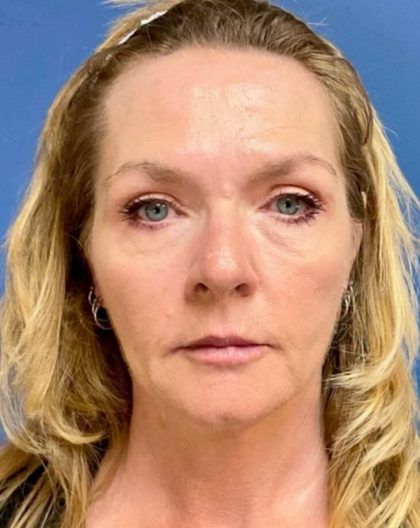 Fillers Before & After