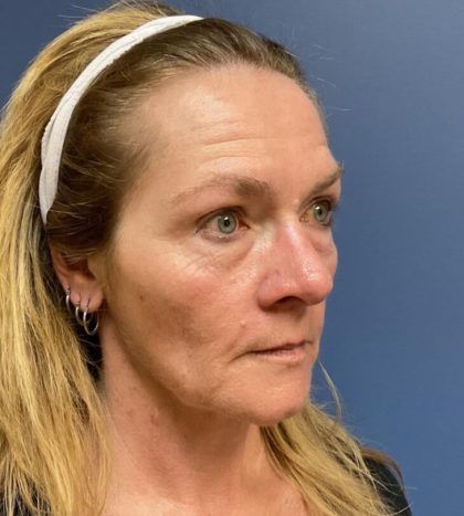 Fillers Before & After