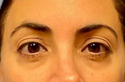 Fillers Before & After