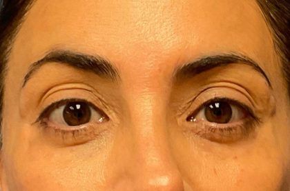 Fillers Before & After