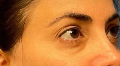 Fillers Before & After