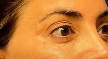 Fillers Before & After