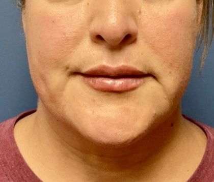 Fillers Before & After