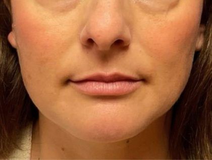 Fillers Before & After