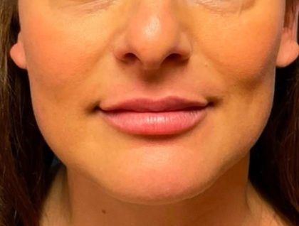 Fillers Before & After