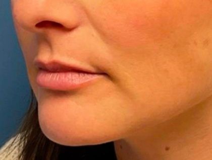 Fillers Before & After