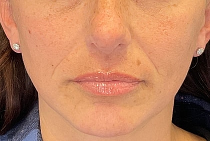 Fillers Before & After