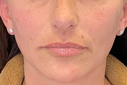 Fillers Before & After