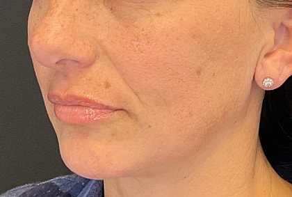 Fillers Before & After