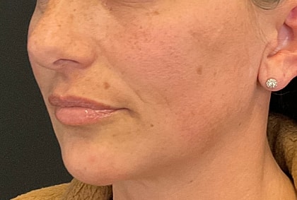 Fillers Before & After