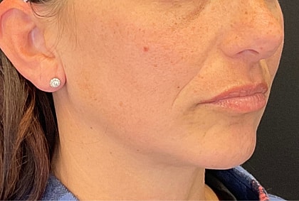 Fillers Before & After