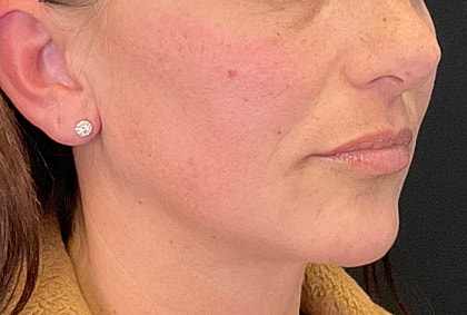 Fillers Before & After