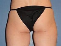 Nonsurgical Skin Tightening Before & After