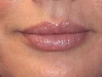 Lip Augmentation Before & After