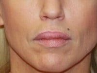 Lip Augmentation Before & After