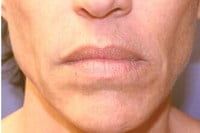 Lip Augmentation Before & After