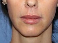 Lip Augmentation Before & After