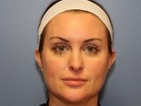 Lip Augmentation Before & After