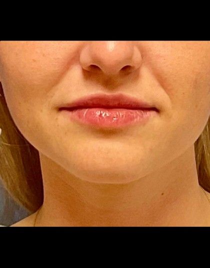 Lip Augmentation Before & After