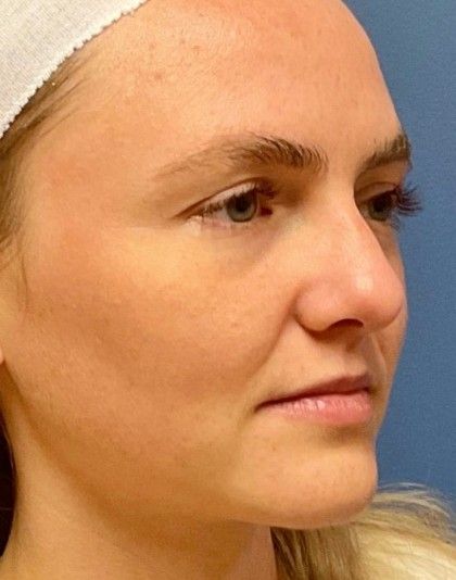 Lip Augmentation Before & After