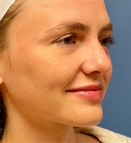 Lip Augmentation Before & After