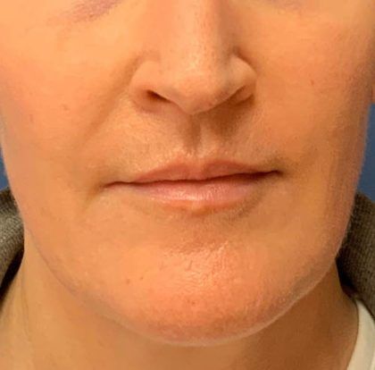 Lip Augmentation Before & After