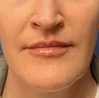 Lip Augmentation Before & After