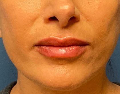 Lip Augmentation Before & After