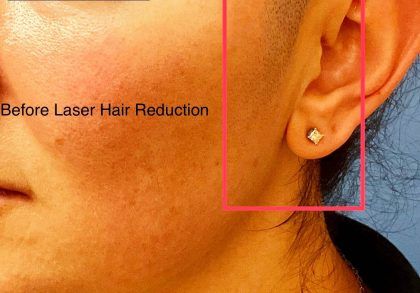 Laser Hair Reduction Before & After