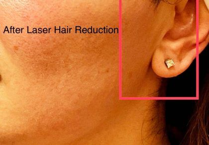 Laser Hair Reduction Before & After