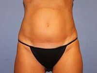 Coolsculpting Before & After