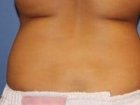 Coolsculpting Before & After