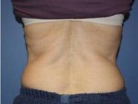 Coolsculpting Before & After