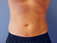 Coolsculpting Before & After