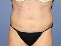Coolsculpting Before & After
